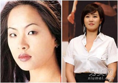 ​金善雅整容，金三顺整容