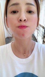 ​陈乔恩晒长痘自拍表示无奈 网友大呼心疼喊话不要熬夜