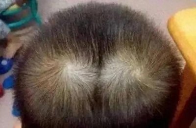 ​孩子头顶“两个旋”，这是聪明的象征吗？揭秘父母必知的秘密！