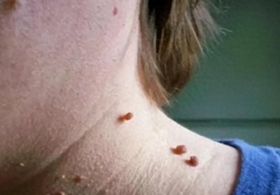 ​脖子和腋下的“小肉粒”是什么？能用手揪掉吗？看完要记清楚