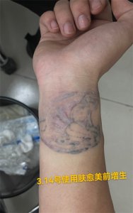 ​洗纹身会留疤吗？