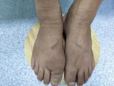 ​降酸茶能代替药物降尿酸吗？