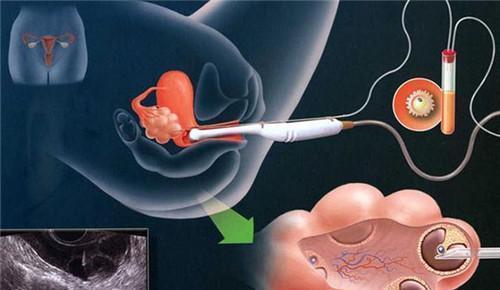 试管婴儿在子宫内的着床过程，有图有真相——看了真为准妈妈揪心